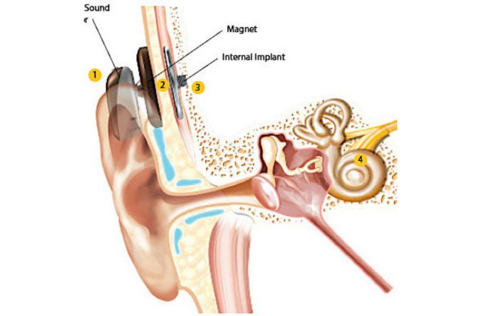 Bone Conduction Hearing Devices by Dr manasa speciality centre bangalore