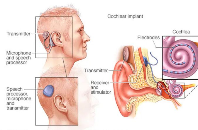 Cochlear Implant Surgery by Dr manasa speciality centre bangalore