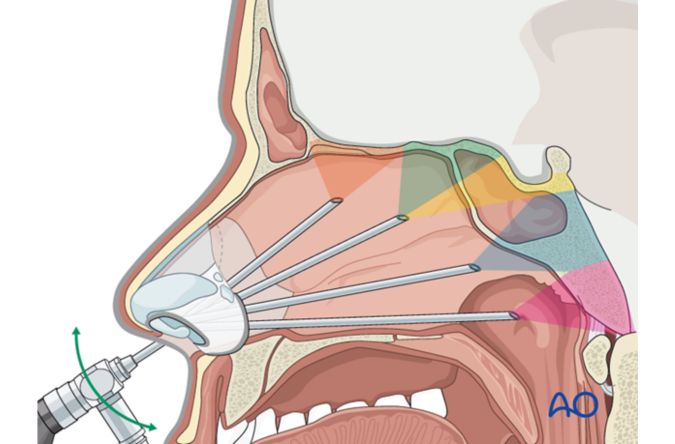 Endoscopic CSF Leak Repair Surgery by Dr manasa speciality centre bangalore