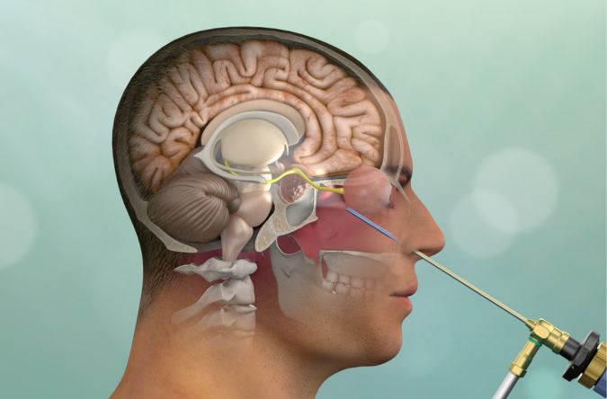 Endoscopic Pituitary Adenoma Surgery by Dr manasa speciality centre bangalore