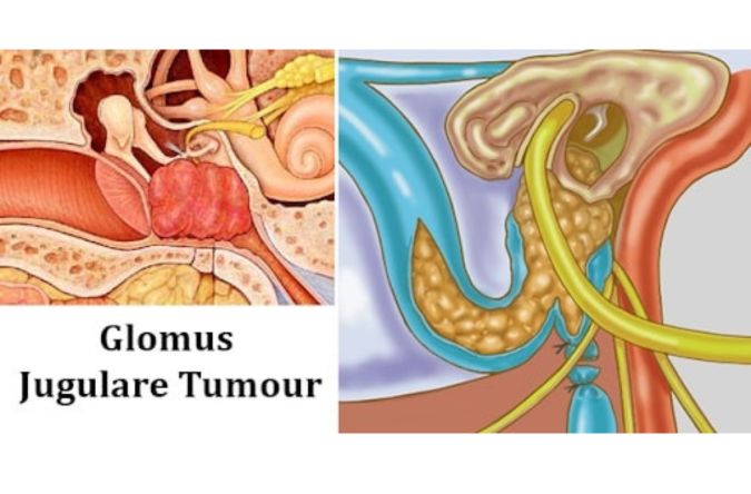 Glomus Jugulare Tumor Surgery by Dr manasa speciality centre bangalore